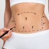 abdominoplastia